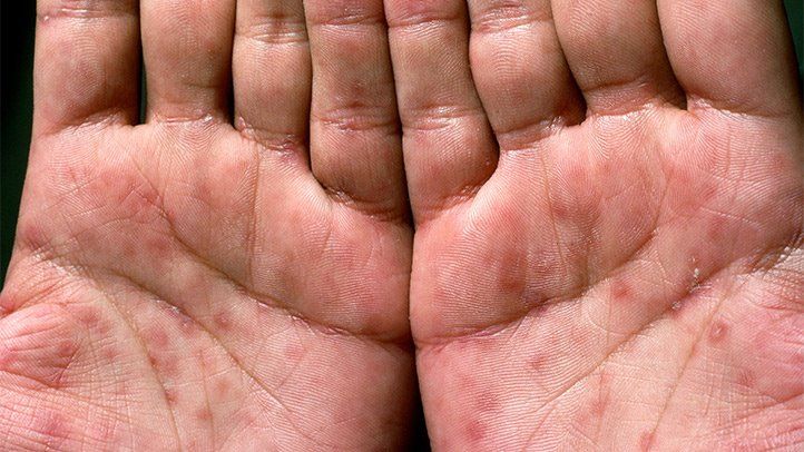 Featured image of post Rash On Palms And Soles Syphilis