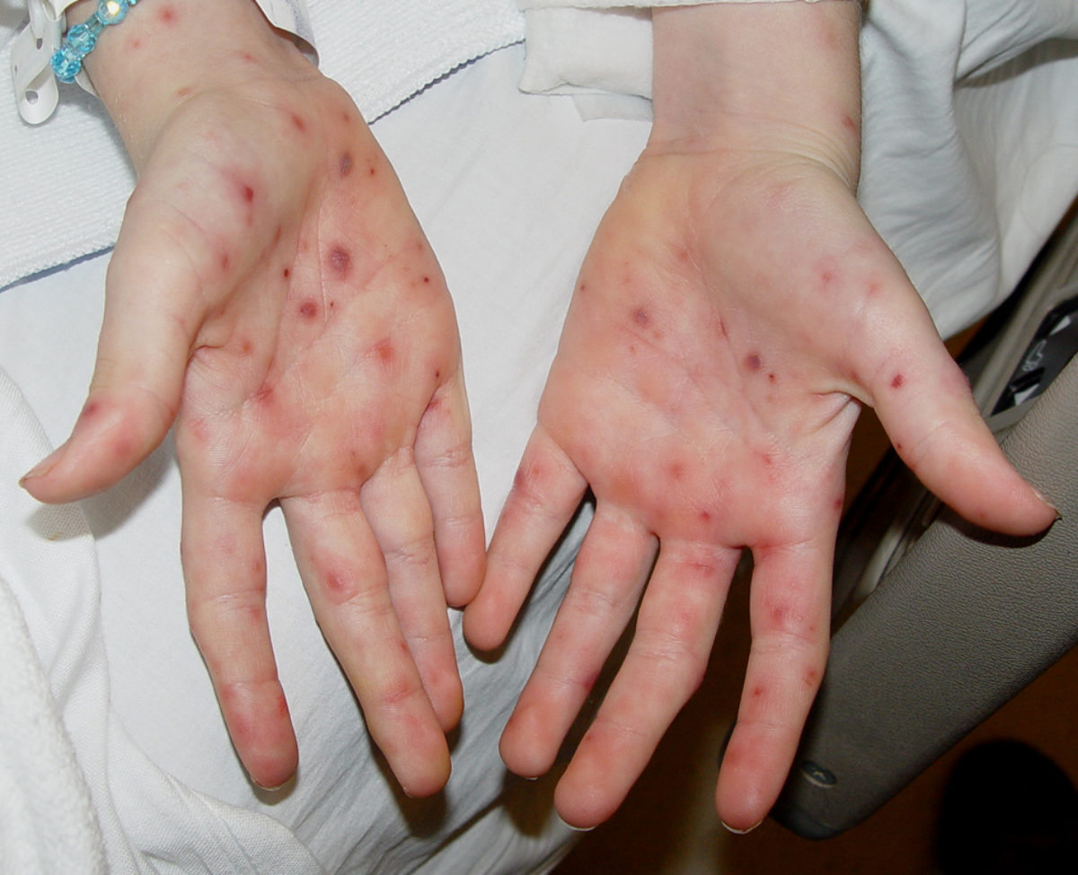 Featured image of post Rash On Palms And Soles Usmle