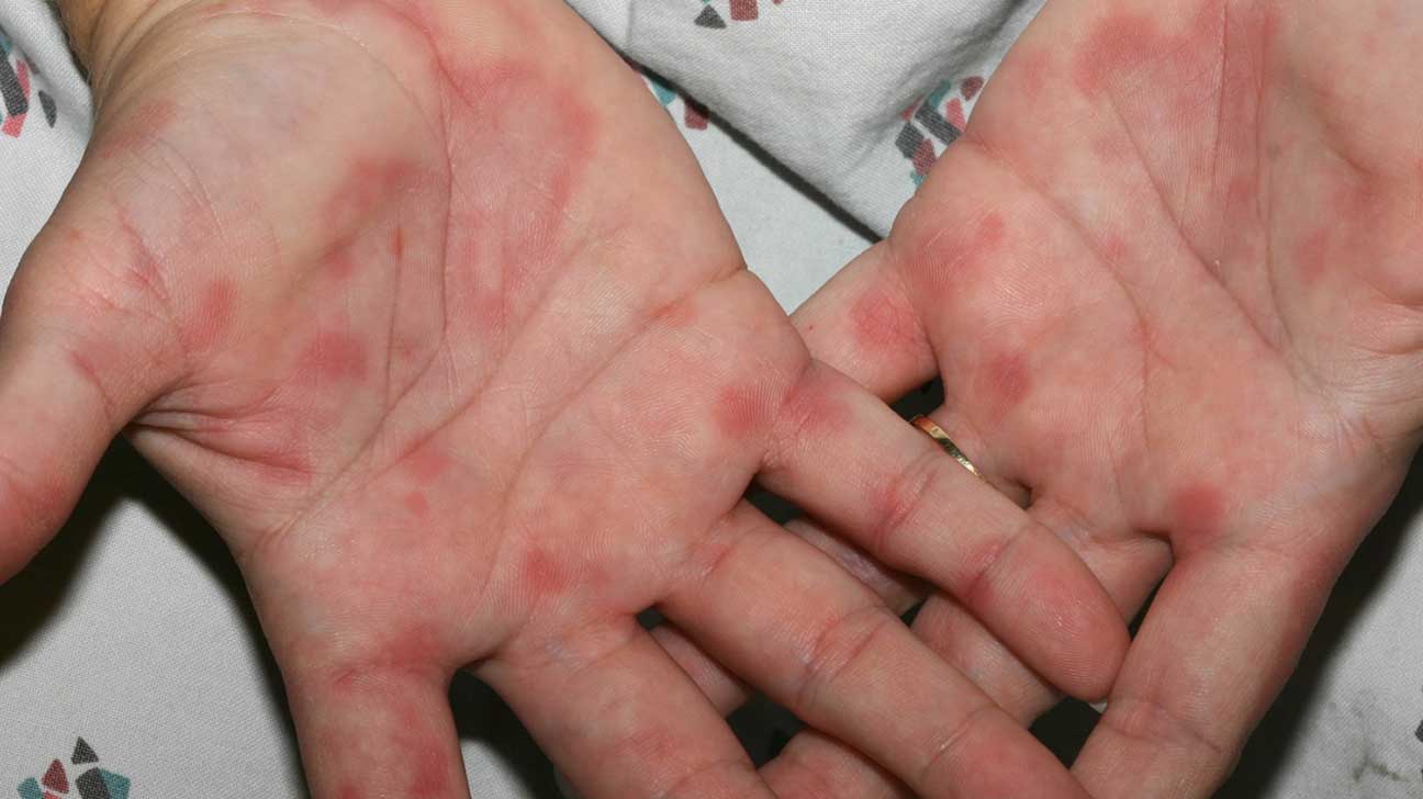 Featured image of post Rash On Palms Of Hands